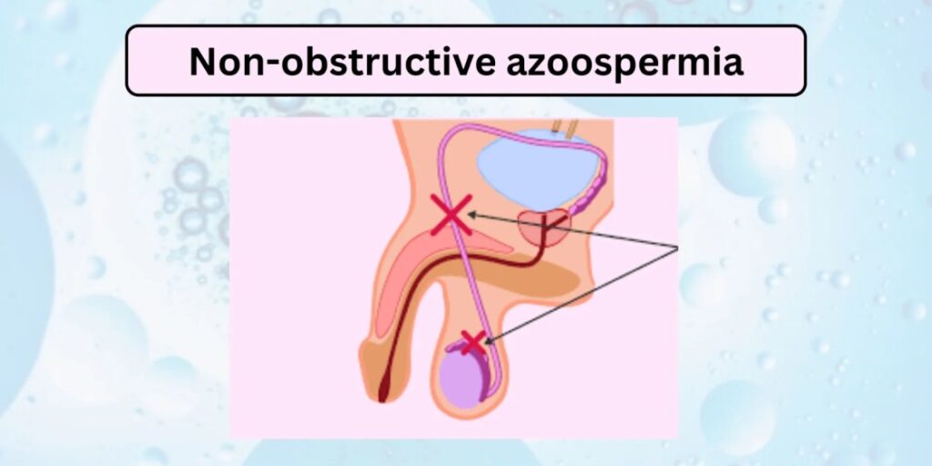 Causes of Non-Obstructive Azoospermia: Genetic, Hormonal & More