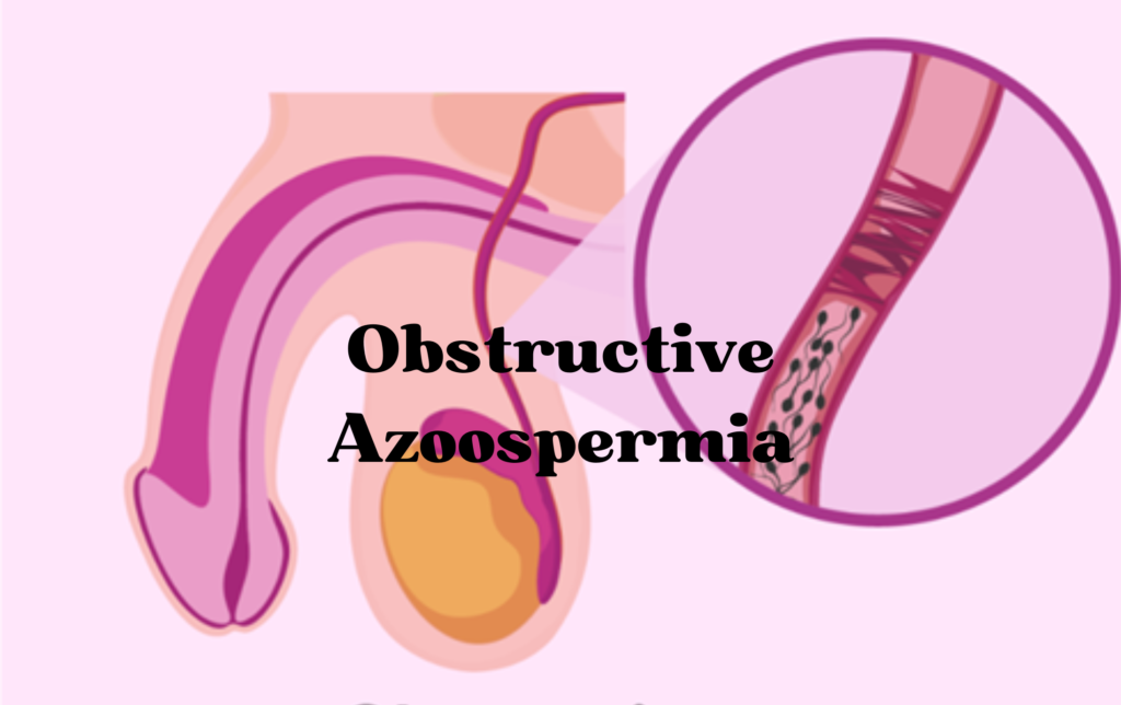 Obstructive Azoospermia