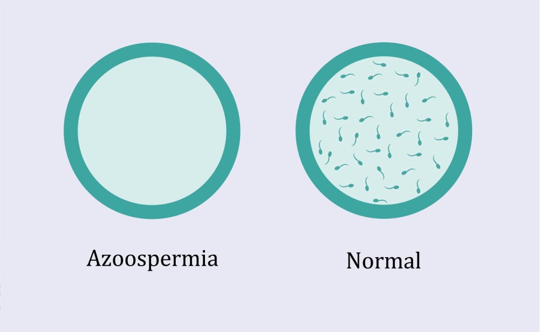 Azoospermia