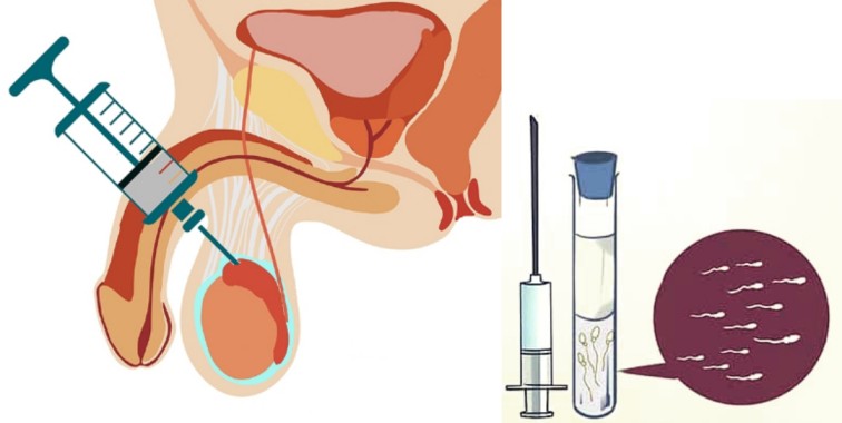 Percutaneous Epididymal Sperm Aspiration (PESA)