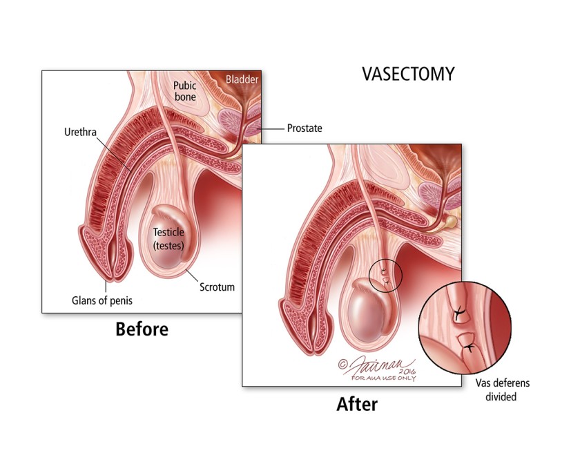 Vasectomy