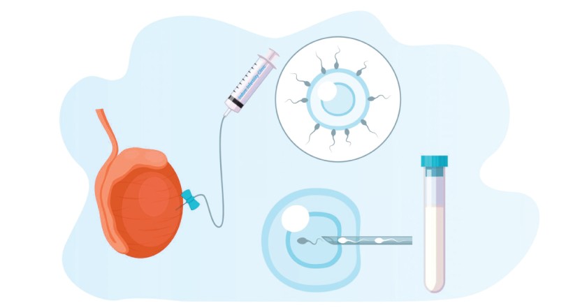 testicle sperm aspiration