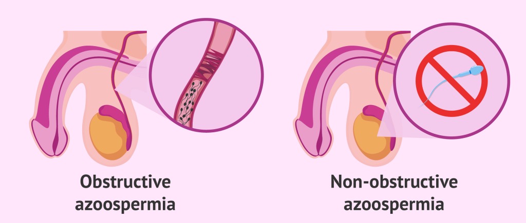 Is Azoospermia Treatable? Exploring Medical and Surgical Solutions   